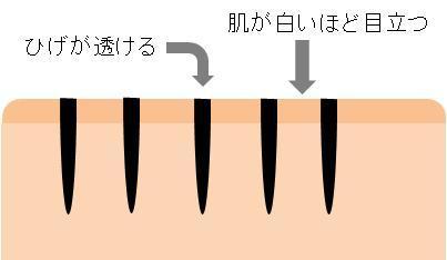 青ひげ対策 京都のメンズ脱毛 ヒゲ脱毛 Men Ssoleil